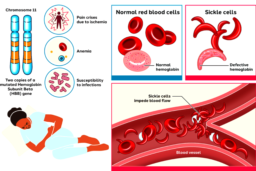 What is Sickle Cell
