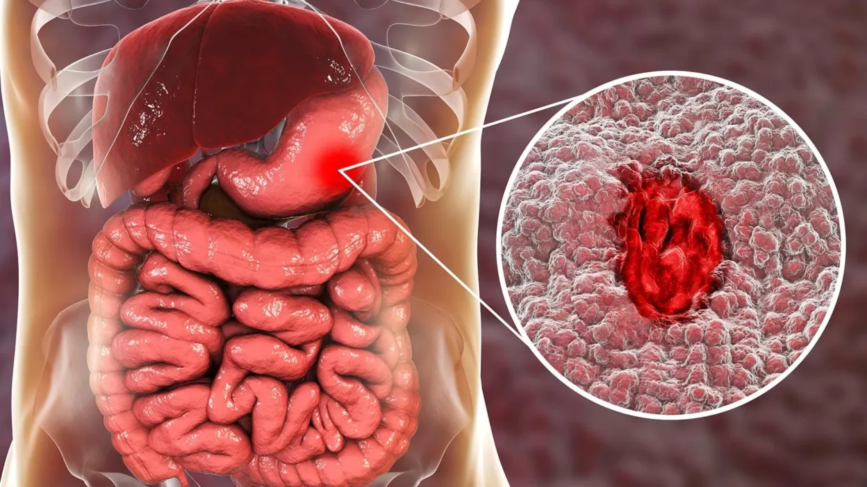 Ulcer vs Gastritis