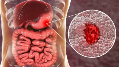 Ulcer vs Gastritis