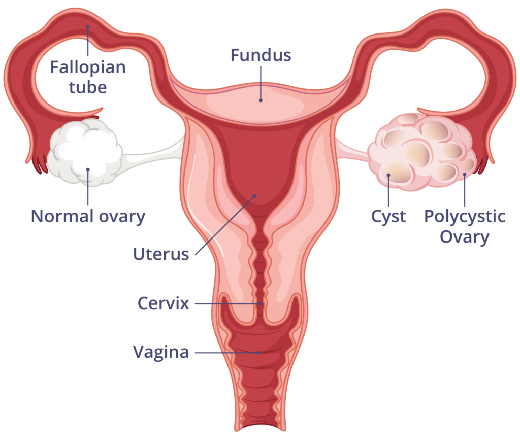 What Is PCOS