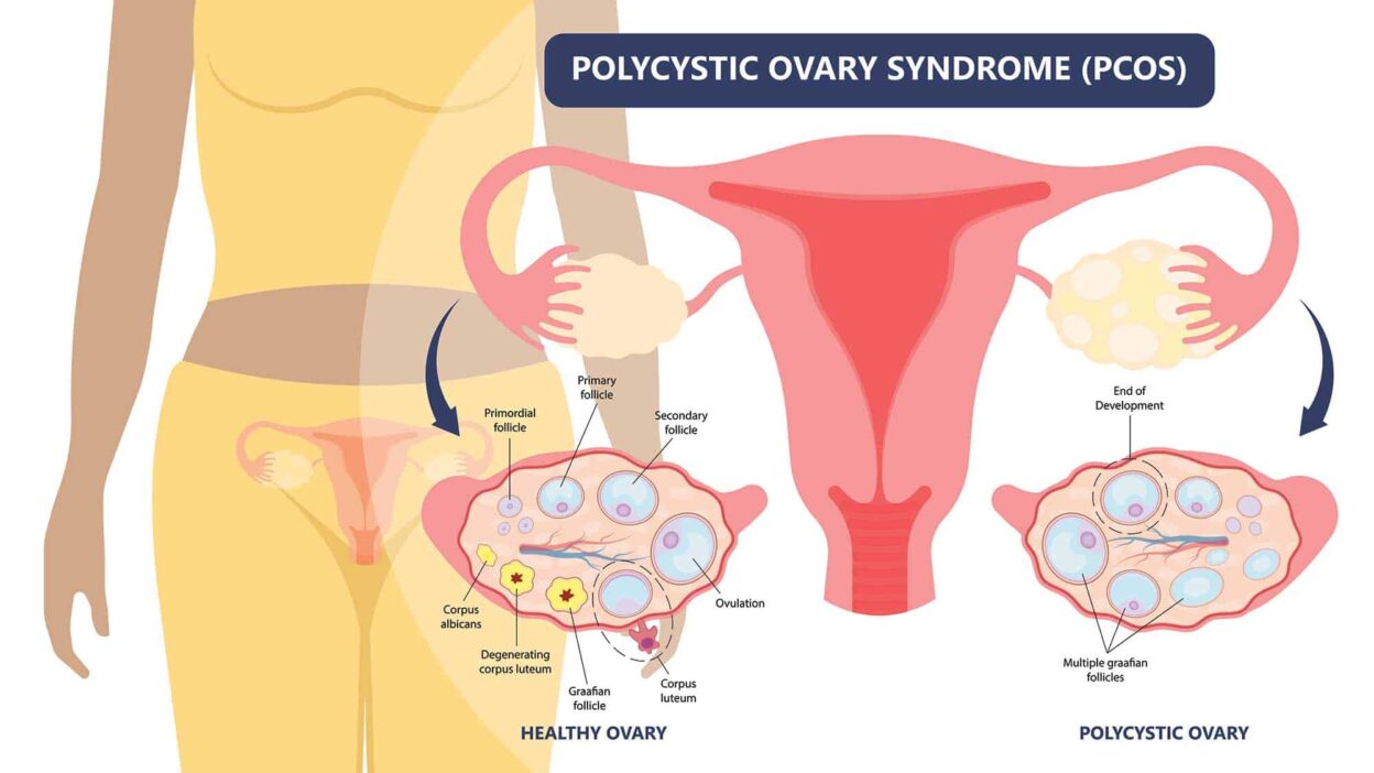 polycystic ovarian syndrome