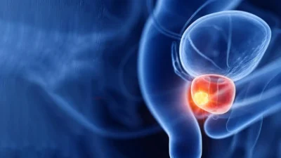 Prostate Cancer